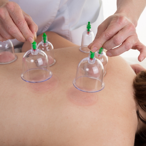 Cupping-Beyond-Physical-Therapy-Franklin-TN