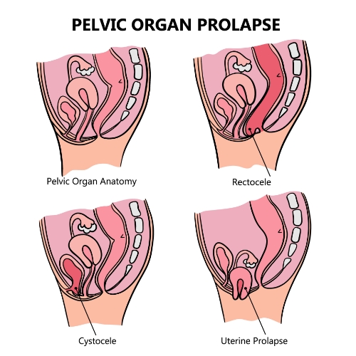 pelvic-organ-prolapse-Beyond-Physical-Therapy-Franklin-TN